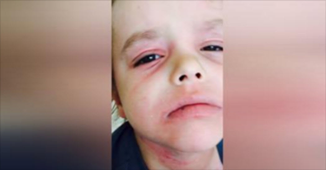 This Is The Beautiful Story Of A Little Boy Beating Crippling Eczema 