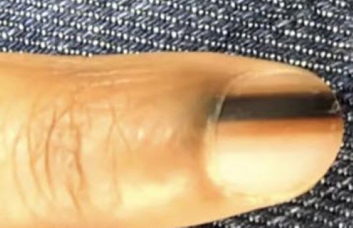 this-black-line-on-your-fingernail-is-serious-business-viral-videos